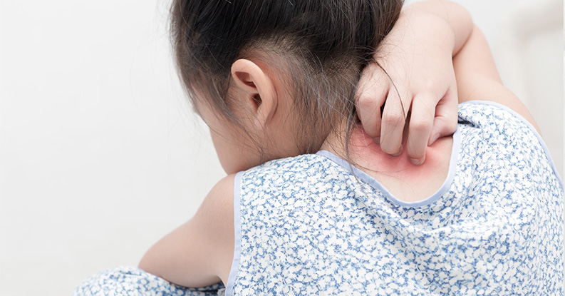 Dermatite atopica e terapia omeopatica